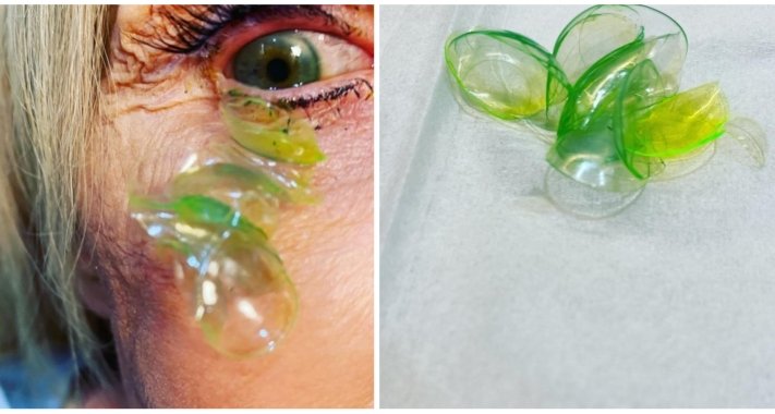 Doktorica izvadila 23 kontaktne leće iz oka pacijentice: “Nikad nisam vidjela nešto slično”