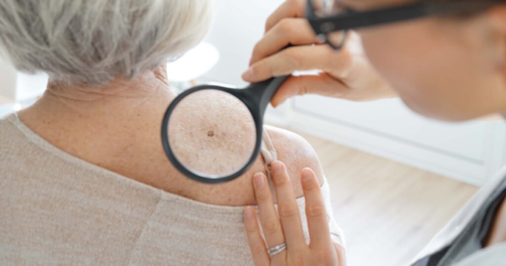 Rak kože jedan je od rijetkih karcinoma koje sami možemo vidjeti