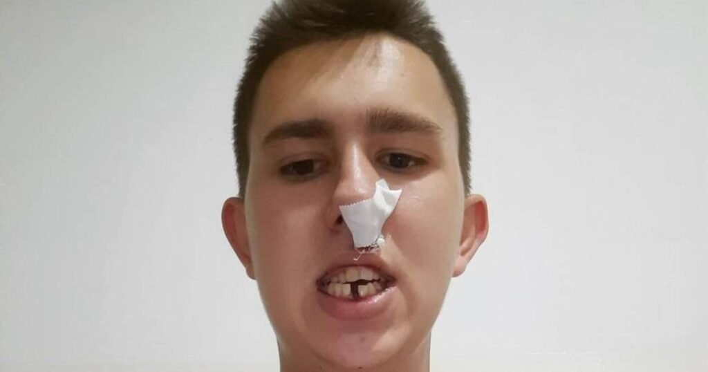 U Bratuncu pretučen mladić Osman Mehanović: Izboli su ga, slomili mu nos i izbili zub