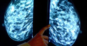 Nosivi ultrazvučni skener mogao bi ranije otkriti rak dojke