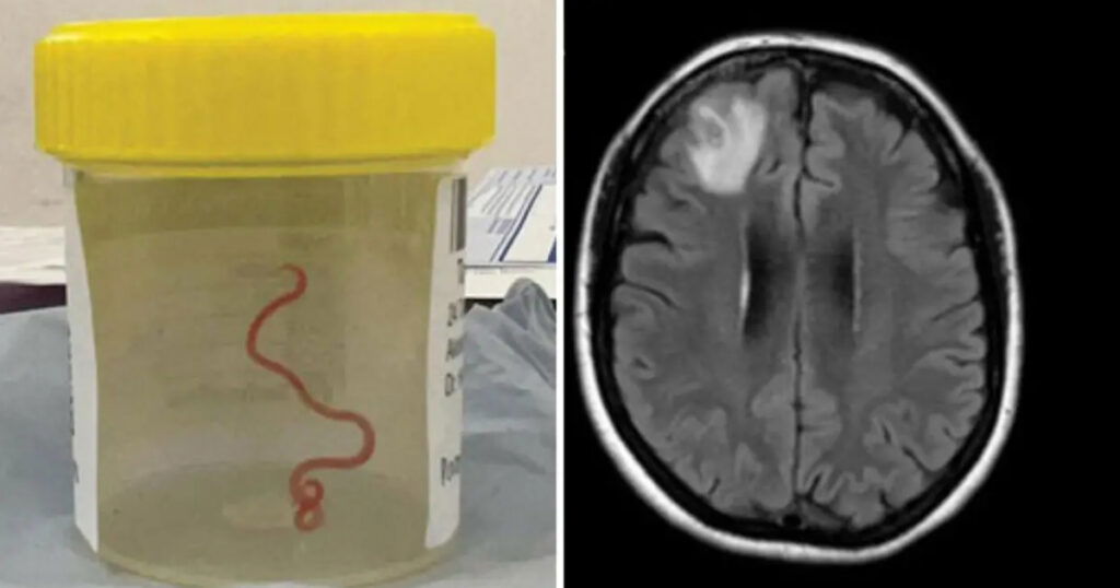 Prvi slučaj u svijetu: Ženi iz mozga izvukli živog crva dugog osam centimetara
