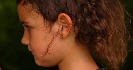 Dječaka dok se igrao napao pit bull i poderao mu lice, ranu su ušili sa 30 šavova