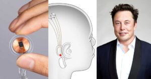 Musk: Ugradili smo čip u mozak čovjeka, zvat će se Telepathy. Evo čemu će služiti