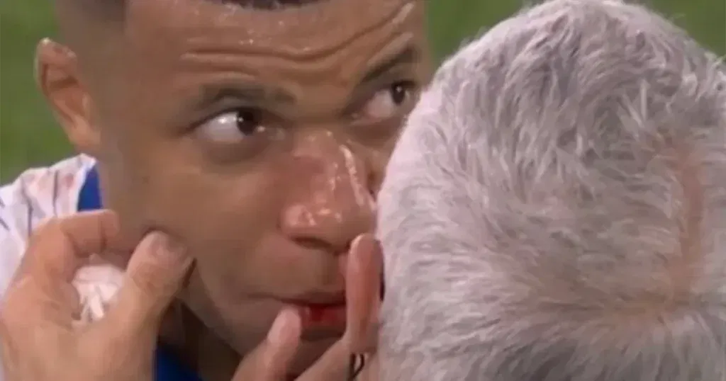 Deschamp otkrio u kakvom je stanju Mbappe nakon što je sav u krvi napustio teren