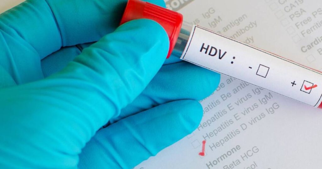 Hepatitis D često ostaje neotkriven, uprkos mogućnostima liječenja