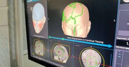 Zenički neurohirurzi obavili prvu operaciju tumora mozga uz upotrebu uređaja za neuronavigaciju